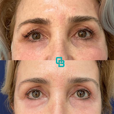 Blefaroplastie Chirurgicala Superioara Operatie Pleoape Cazute