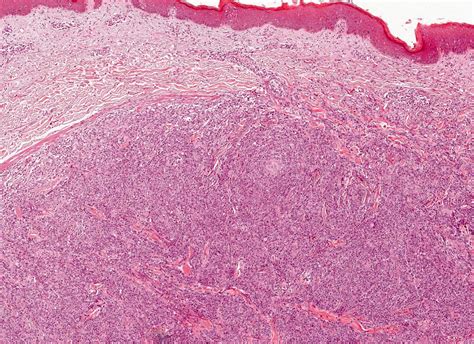 Pathology Outlines Peripheral T Cell Lymphoma Nos