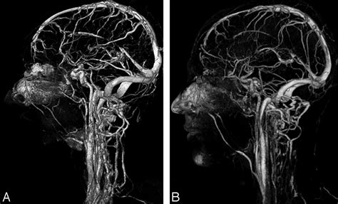 Diagnosis And Management Of Cerebral Venous Thrombosis, 55% OFF