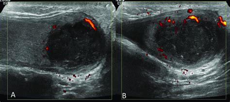 Color Doppler Ultrasound Sagittal A And Axial B Color Doppler