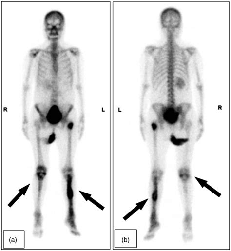 Whole Body Bone Technetium 99 M Scans Postoperative Technetium 99 M Download Scientific