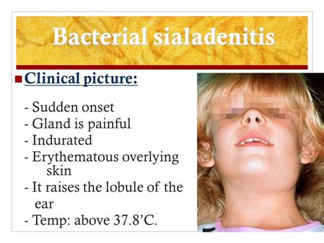 Sialadenitis Treatment With Antibiotics