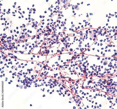 Yeast Infection Budding Yeast And Pseudohyphae Of Candida Albicans