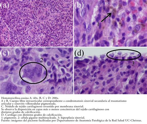 Tratamiento artroscópico de sinovitis villonodular pigmentada de