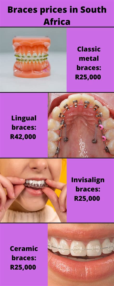 How Much Do Braces Cost For Year Olds At Edward Coplin Blog