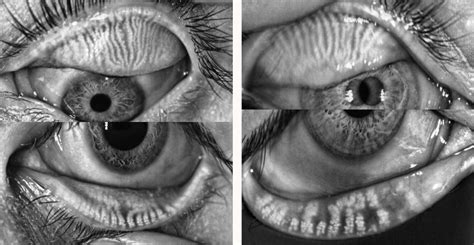 Meibomian Gland Anatomy