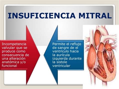 Insuficiencia Mitral Por Tatiana Palaciosuniversidad De Guayaquil