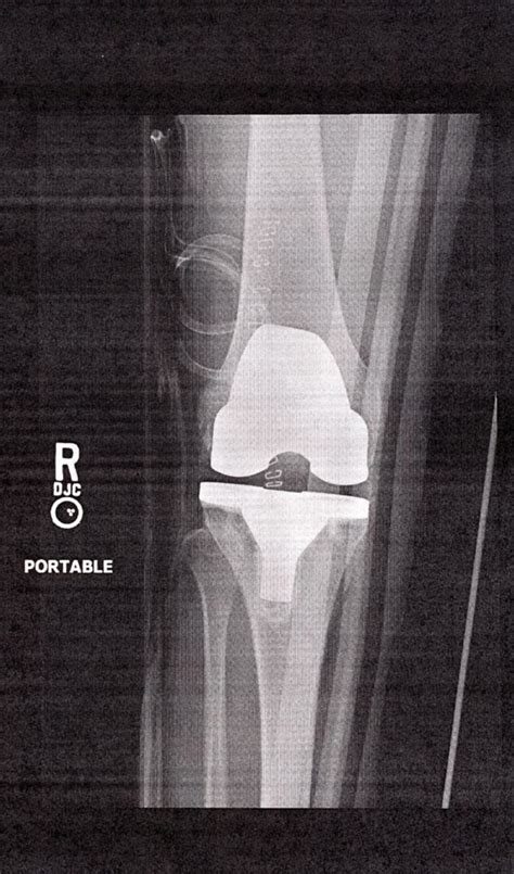 My Experience With Total Knee Replacement Surgery | HealDove