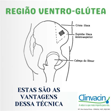 Região ventro glúteo essas são as vantagens dessa técnica