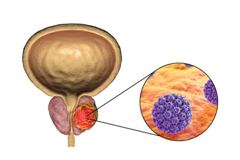 Czym charakteryzuje się biopsja fuzyjna prostaty Porady i newsy dla