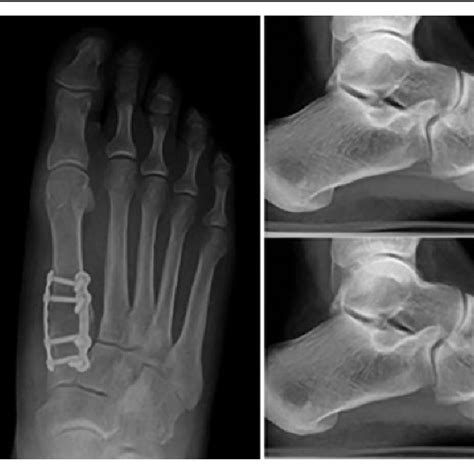 Preoperative And Postoperative Anteroposterior And Lateral Radiographic Download Scientific