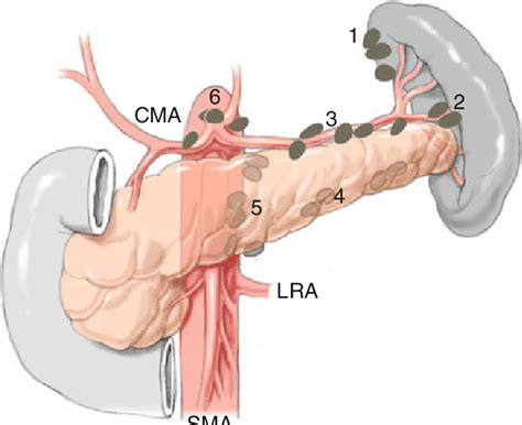 20 Relevant Lymph Node Stations For Carcinomas Of The Body Or Tail Of Download Scientific