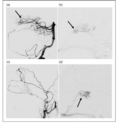 Arteriovenous Fistulas Of The Vein Of Galen Region In Adults