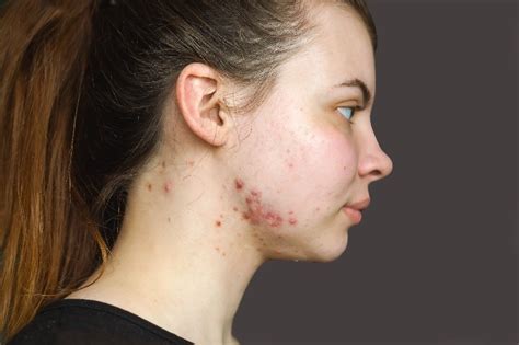 Keloids Acne