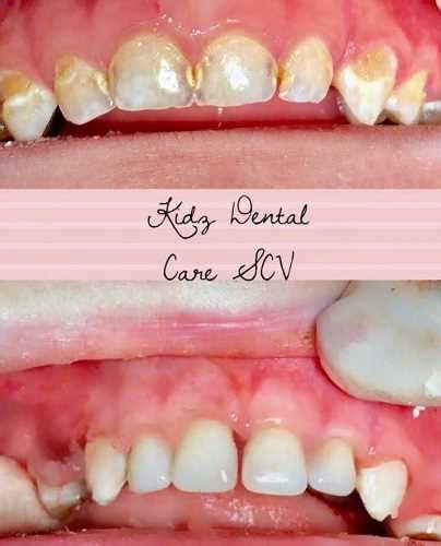 Why should cavities in baby teeth need to be treated?