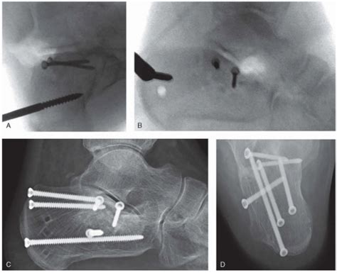 Fractures Of The Calcaneus Musculoskeletal Key