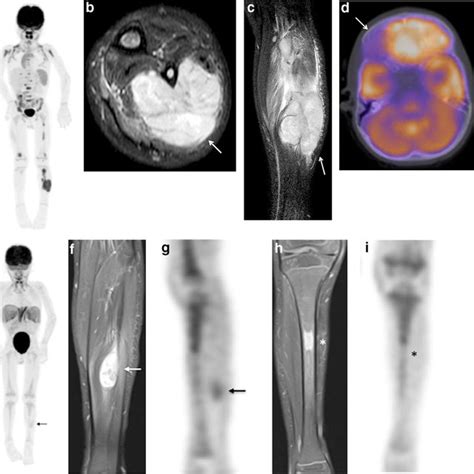 Iodine Metaiodobenzylguanidine I Mibg Scintigraphy And