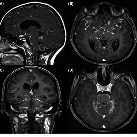 Brain Magnetic Resonance Imaging T1 Weighted Images After Download Scientific Diagram