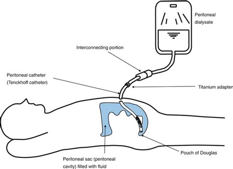 Peritoneal Physiology and Peritoneal Membrane | Abdominal Key