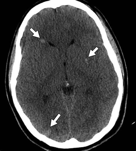 Cerebral Edema Ajr