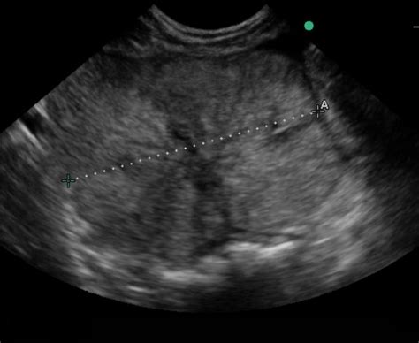 Benign Prostatic Hypertrophy Ultrasound