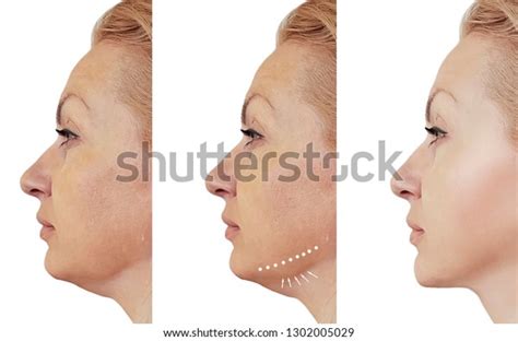 Woman Double Chin Before After Procedures Stock Photo Edit Now 1302005029