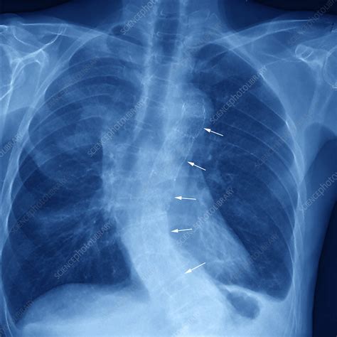 Stent In Thoracic Aorta Angiogram Stock Image M1750598 Science