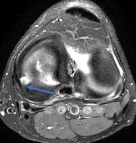 Top 92 Pictures Pictures Of Knee With Torn Meniscus Completed