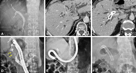 A Novel Method Of Bilateral Biliary Decompression By Eus Guided