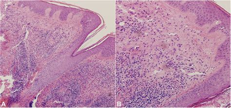 Refractory Granuloma Faciale Successfully Treated With Adjunct Topical