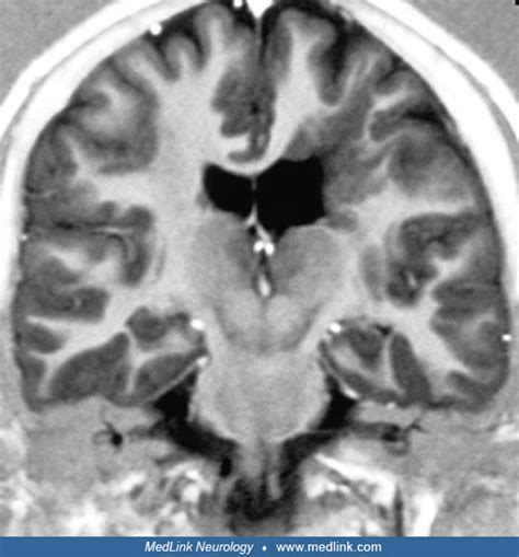 Schizencephaly | MedLink Neurology