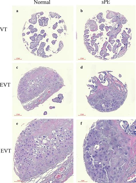 Hematoxylin And Eosin Hande Staining Of The Placental Tma A C E Hande Download Scientific