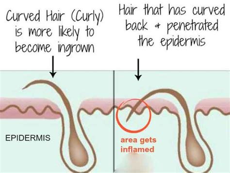 Ingrown Hair Vs Herpes Ingrown Hair Or Herpes Whats The Difference Curehows