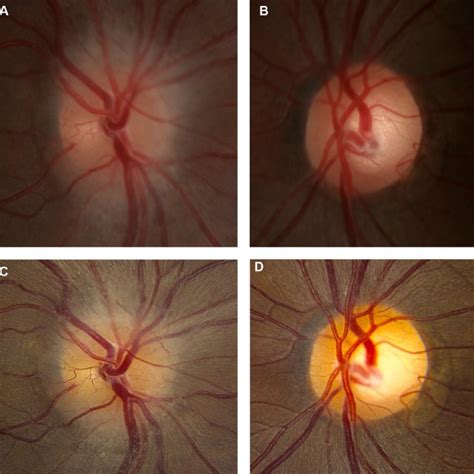 Nonarteritic Anterior Ischemic Optic Neuropathy Naion In The Left Eye Download Scientific