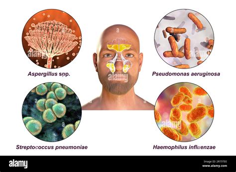 Rhinosinusitis And Microorganisms That Cause Sinusitis Fungi