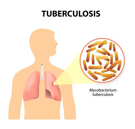 Tuberculosis Tuberculosis Dr Ankit Parakh It Can Develop When