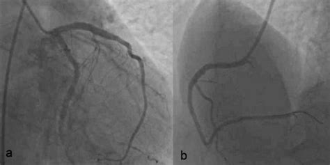 A B A Patent Lad Stent Without Aneurysm B Image Of Rca After Bms
