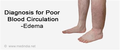 How To Fix Poor Blood Circulation Relationclock