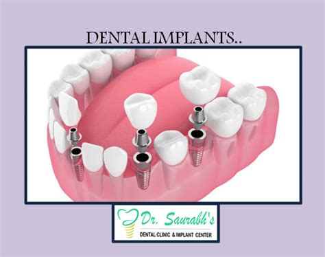 Dr Saurabhs Dental Clinic And Implant Center Udaipur Darpan