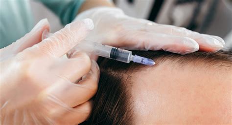 Los Beneficios De La Mesoterapia Capilar Revitaliza Tu Cabello Sin Cirugía Imd