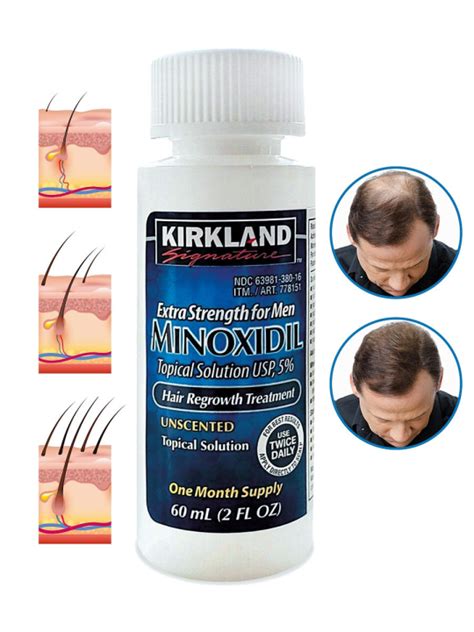 Best Selling Kirkland Signature Minoxidil 5 Extra Strength Hair