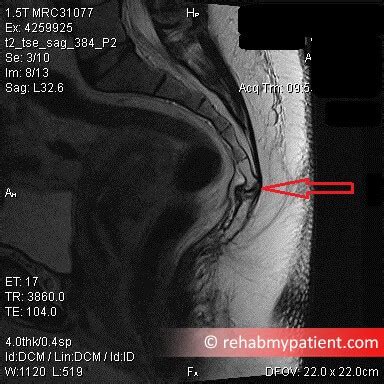 Coccyx Fracture | Rehab My Patient