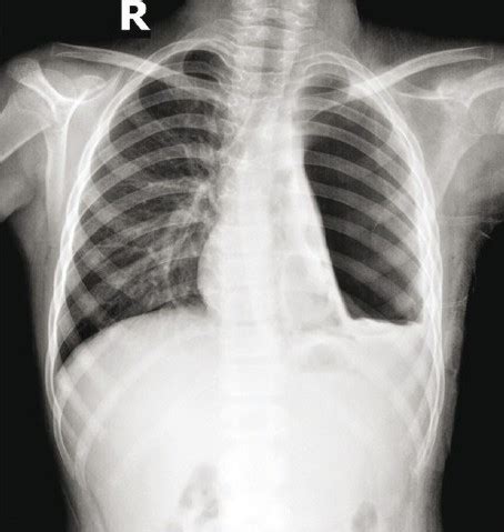 Chest X Ray Showing Left Hydropneumothorax Open I