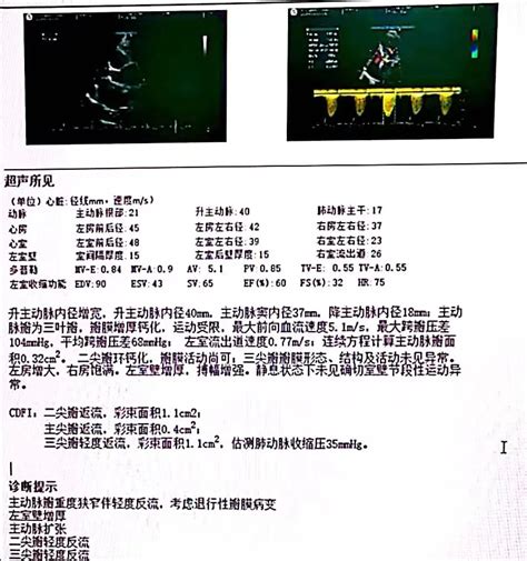 专注尊术，博学重道，不断提升服务能力：成都医学院第一附属医院心内科团队独立完成主动脉瓣病变冠心病的pcitavr一站式手术 严道脑血管网