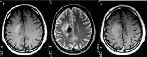 Figure From Solitary Brain Metastasis From Classic Biphasic Pulmonary