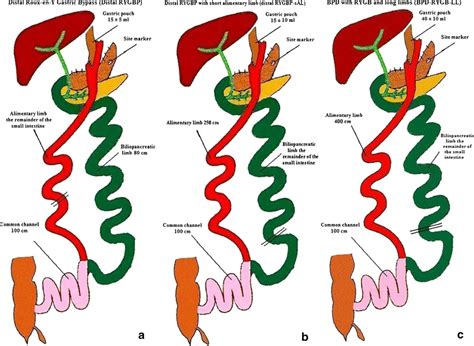 Schematic Representation Of The Studied Procedures A Distal Roux En Y