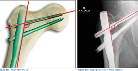 Figure From Prise En Charge Des Fractures Per Trochant Riennes