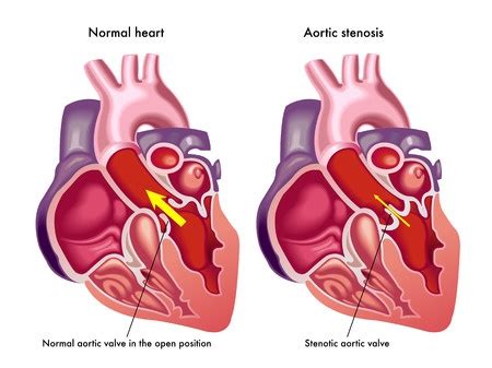 Guide To Heart Murmurs Aortic Stenosis Murmur Stepwards