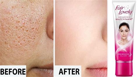 How To Get Rid Of Large OPEN PORES Permanently With Fair Lovely