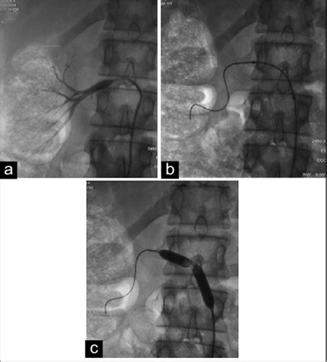 Angioplasty For Right Renal Artery Stenosis Diagnostic Angiography A Download Scientific